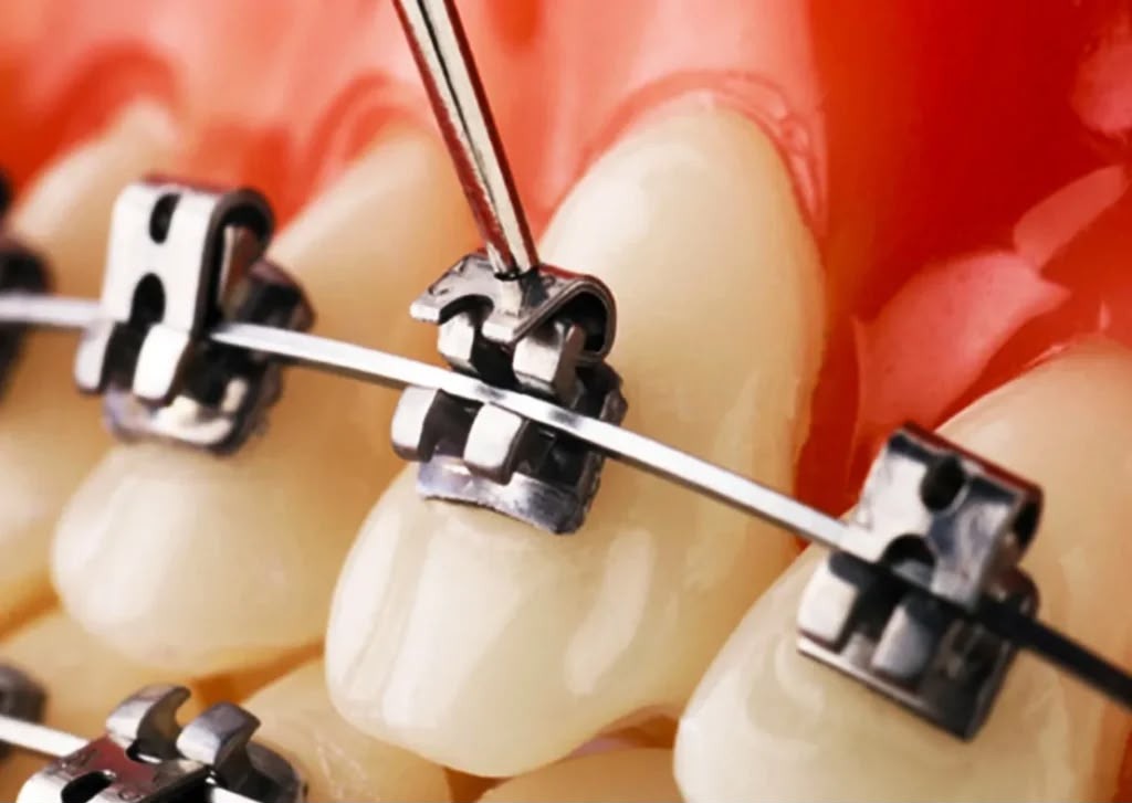 Metal Self-Ligating Brackets