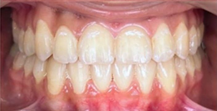 Orthodontic Real Teeth Treatment Result - After