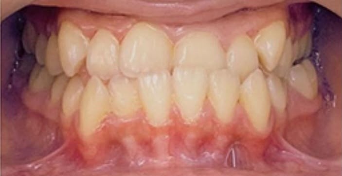 Orthodontic Real Teeth Pre-Treatment - Before