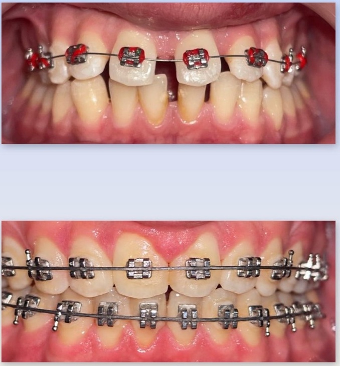 Case 1: Gaps and Spacing Closure with Braces