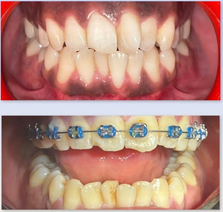 Case 2: Tooth Rotations Correction with Braces